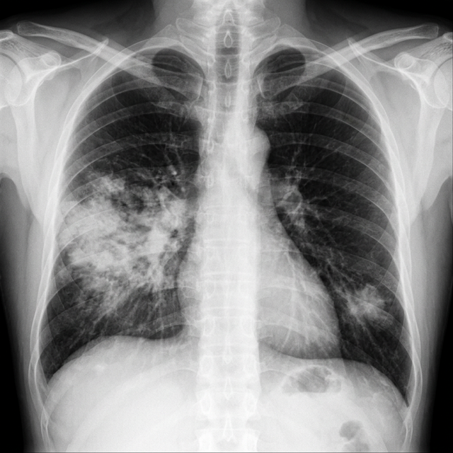 Sample radiograph with pneumonia
